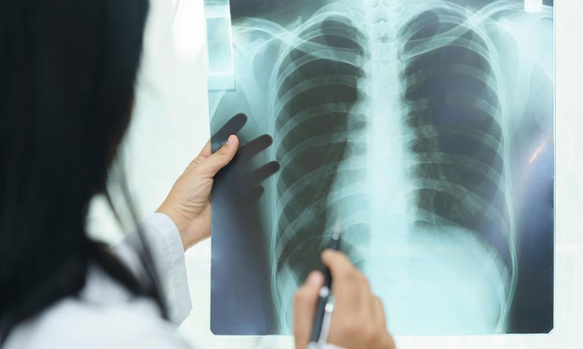 La Tuberculosis continúa en aumento en nuestro país 